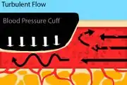 Fig. 4: An artery with a blood pressure cuff where the cuff pressure is less than the systolic, but still greater than the diastolic blood pressure.